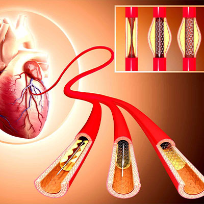 Coronary Angioplasty