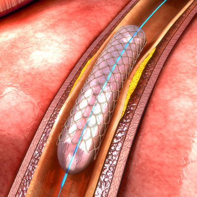 Peripheral Angiogram / Angioplasty