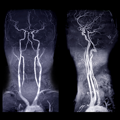 carotid-angiogram-angioplasty