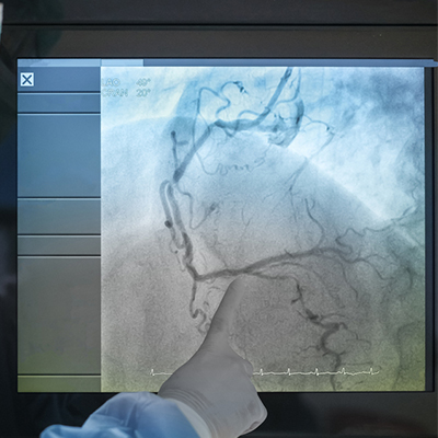 coronary-angiogram
