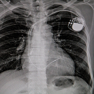Permanent Pacemaker Implantation