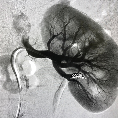 renal-angiogram-angioplasty
